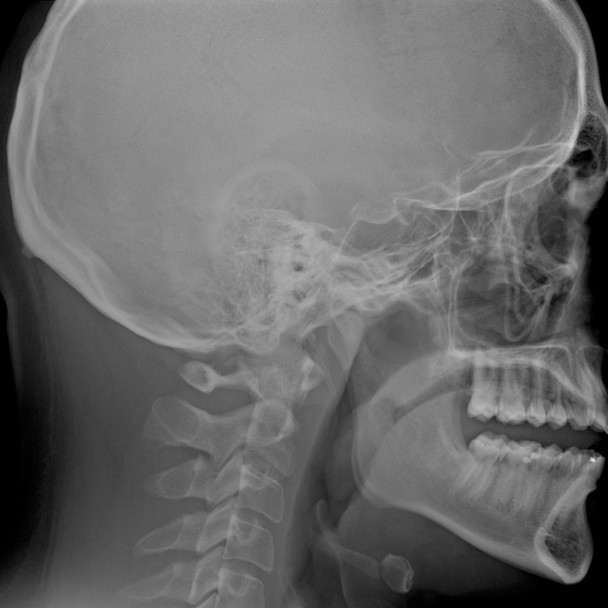 Skull